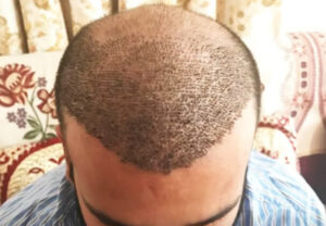 See How Long FUE Transplant Procedure Lasts