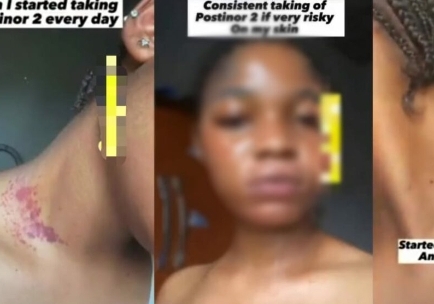 Lady Shares Alarming Skin Reactions After Frequent Use of Postinor-2